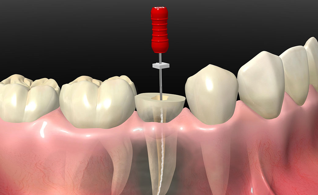 根管治療は歯を救う治療